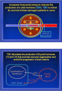 Coimbra intracranial pressure